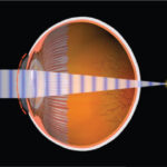 Farsightedness and its Correction