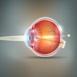Nearsightedness and its Correction